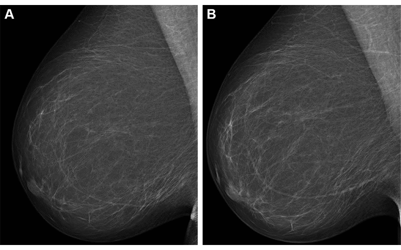 Breast Cancer Risk Results in an Improved Cancer Risk Assessment Using AI