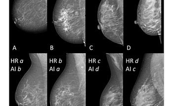 Artificial Intelligence Likely to Detect Breast Density, Says Study